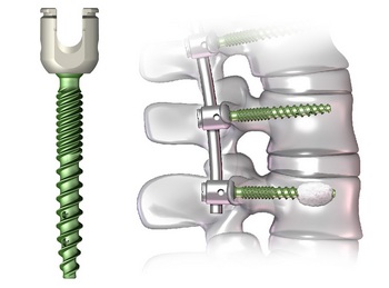 DePuy-Synthes-Viper-and-Expedium.jpg