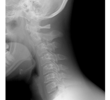 cervical-spine.jpg